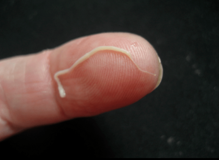 parasite roundworm as an gcorp an duine